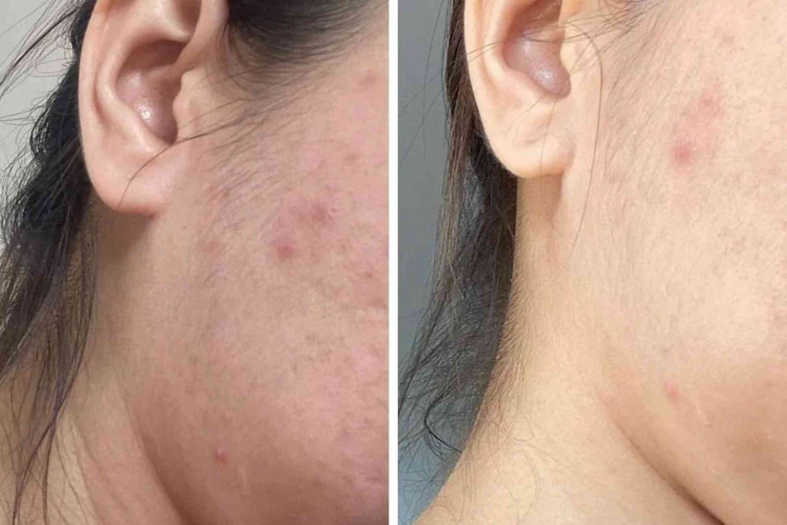how to care for acne prone skin